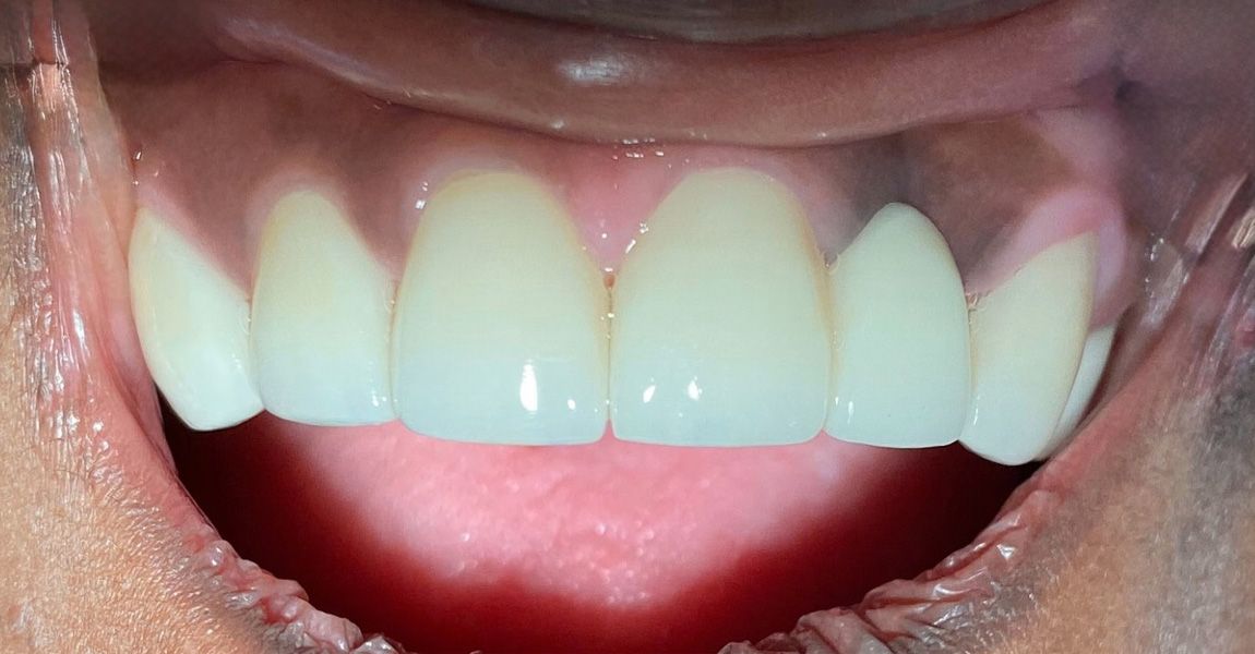 A close up of a woman 's mouth with white teeth.