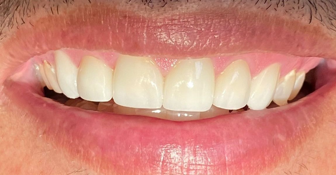 A close up of a woman 's mouth with white teeth.