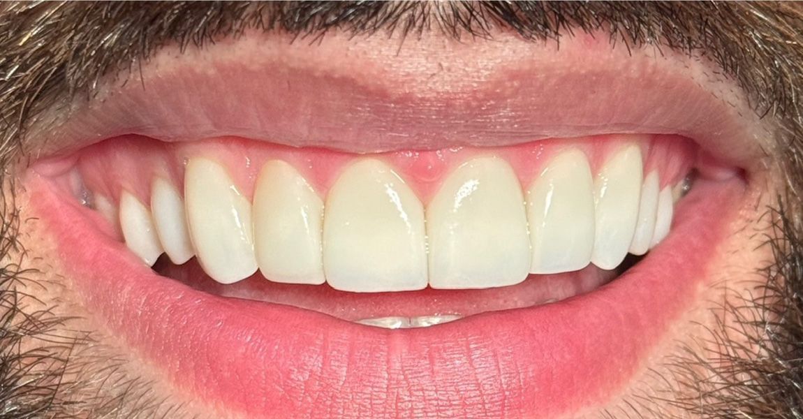 A close up of a woman 's mouth with white teeth.