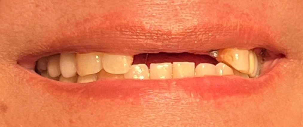 A close up of a woman 's smile with white teeth.