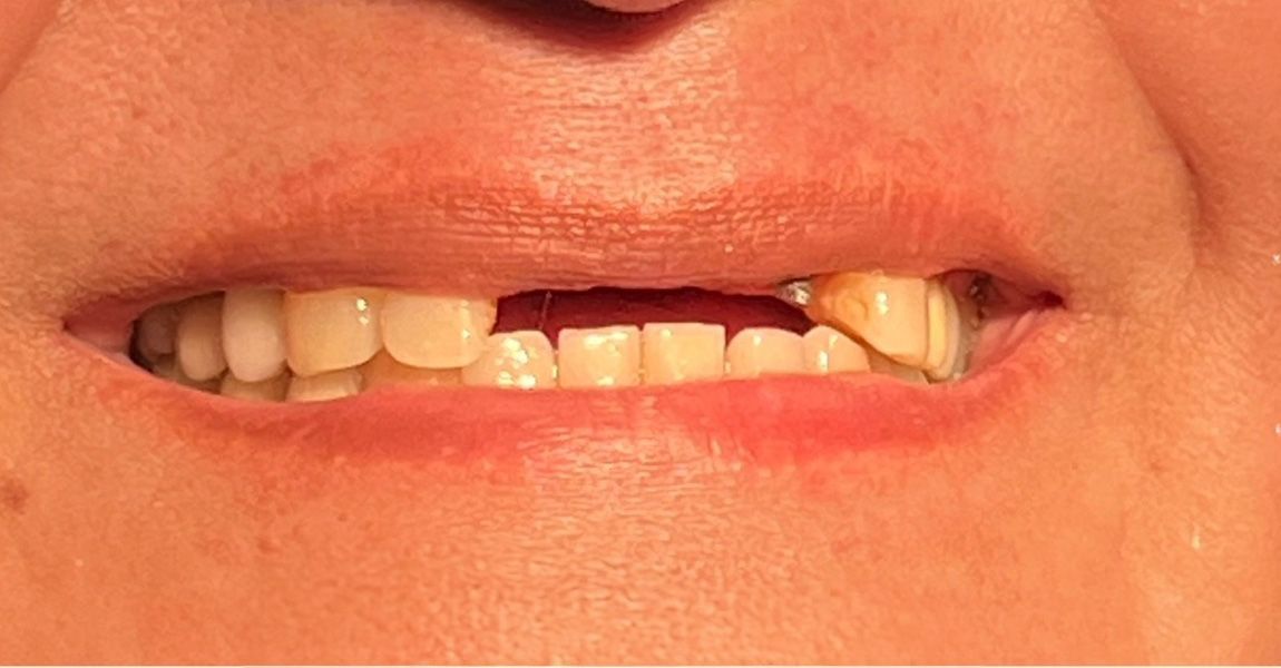 A close up of a woman 's smile with white teeth.