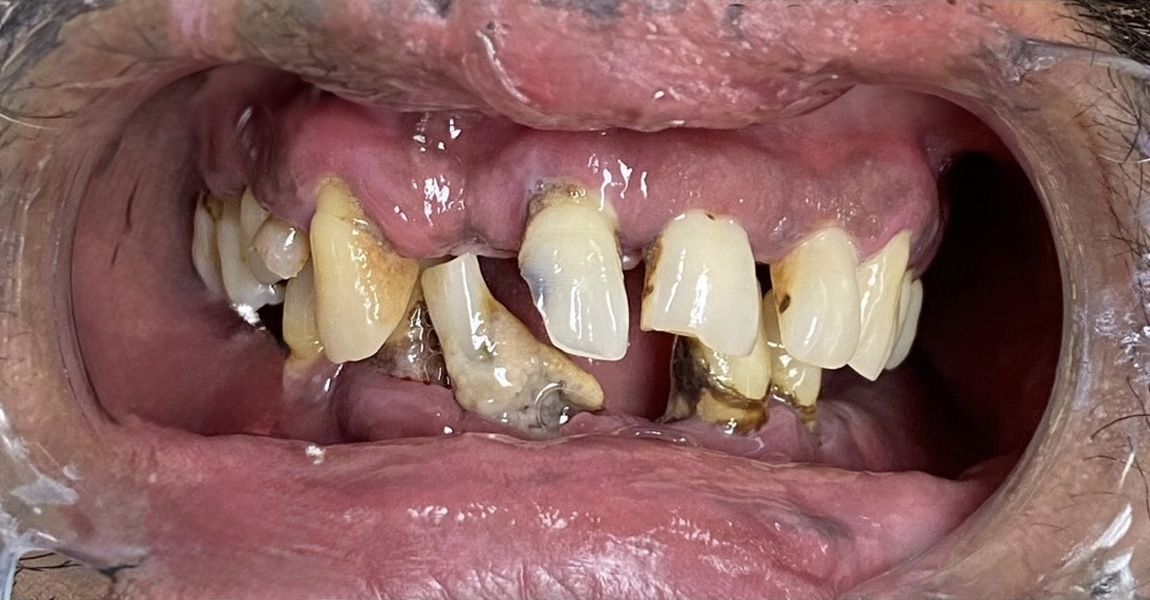 A close up of a woman 's smile with white teeth.