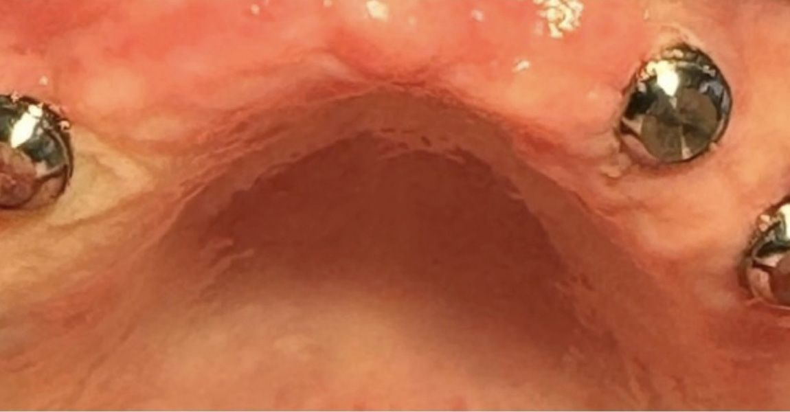 A close up of a man 's teeth with a tooth color chart in his mouth.
