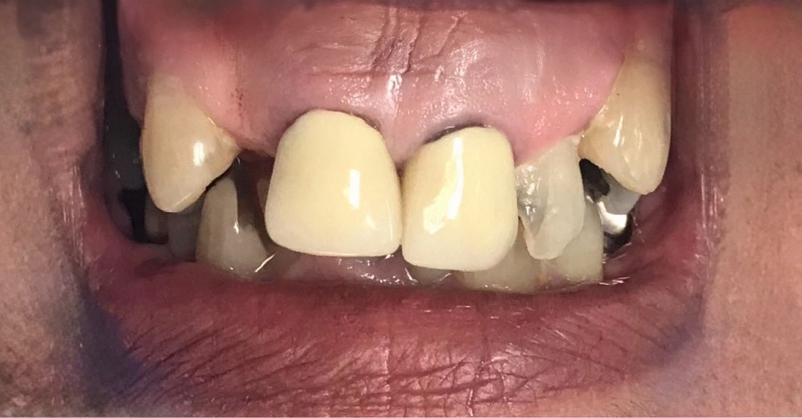 A close up of a woman 's mouth with white teeth.