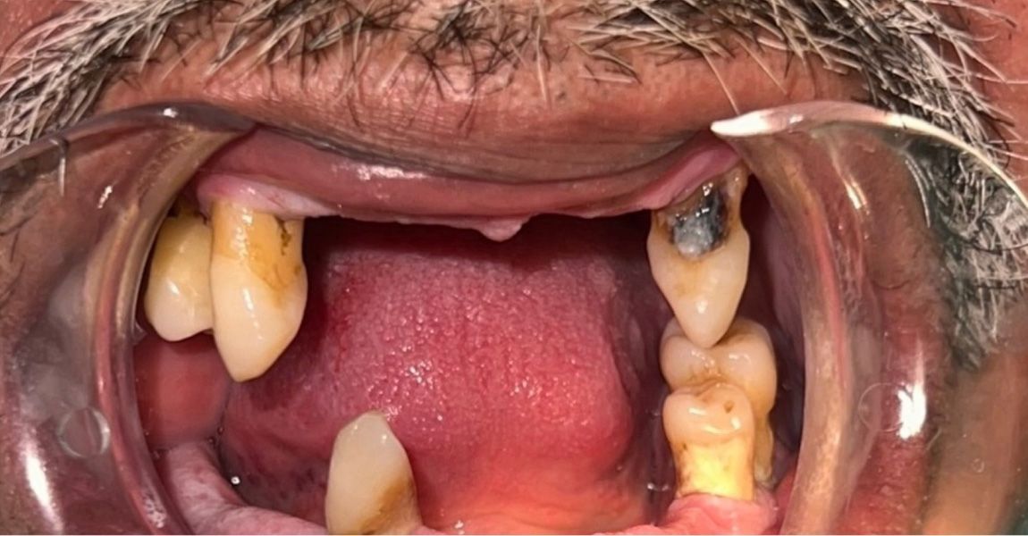 A close up of a person 's teeth with a toothbrush in their mouth.