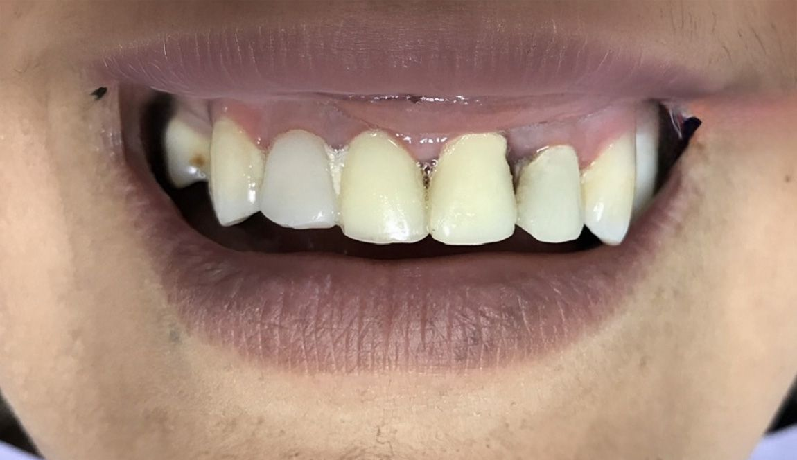 A close up of a woman 's smile with white teeth.