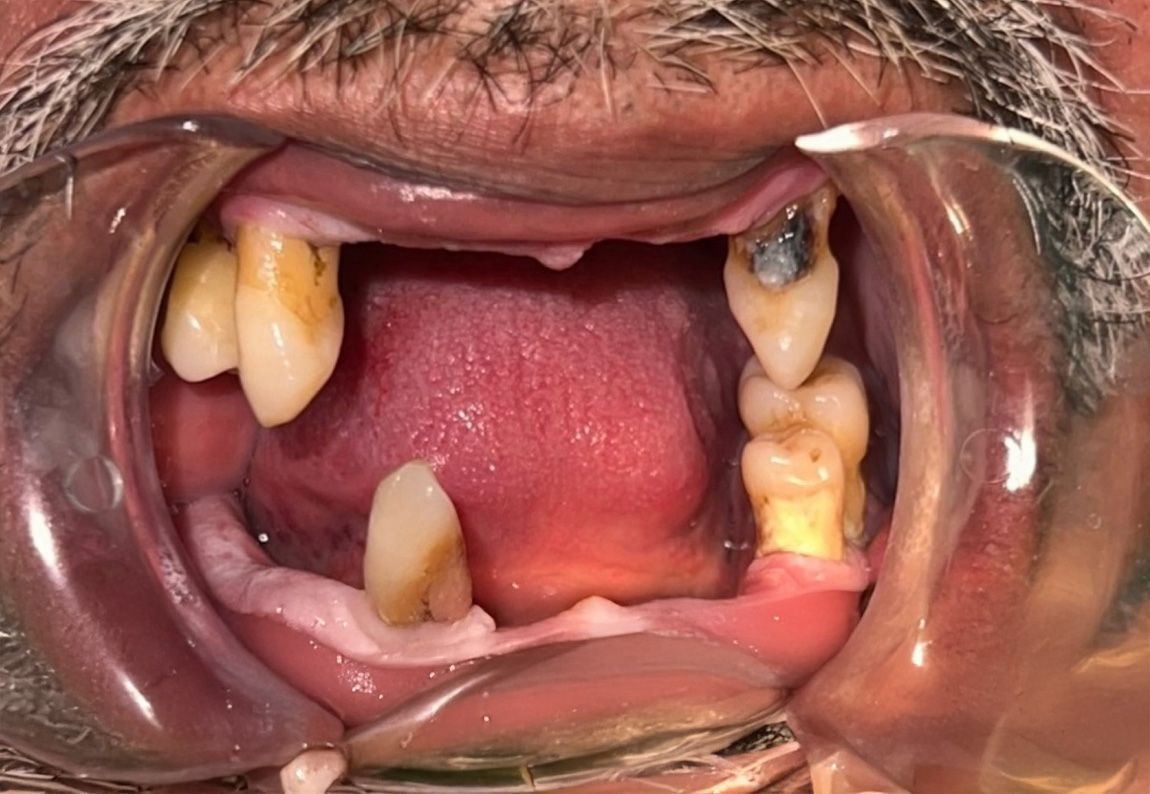 A close up of a person 's teeth with a toothbrush in their mouth.
