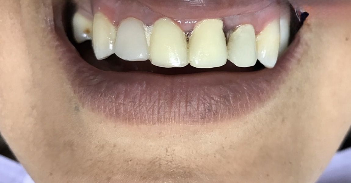 A close up of a woman 's smile with white teeth.