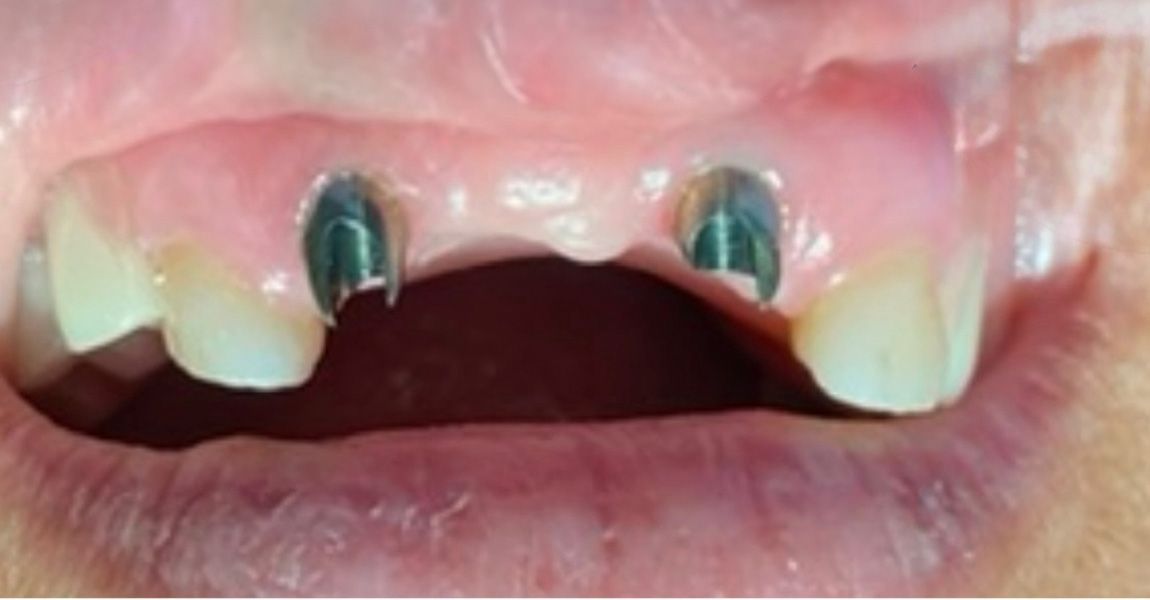 A close up of a woman 's smile with missing teeth.