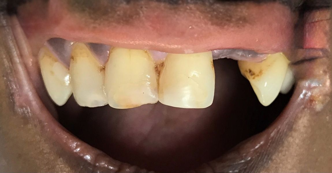 A close up of a woman 's smile with white teeth.