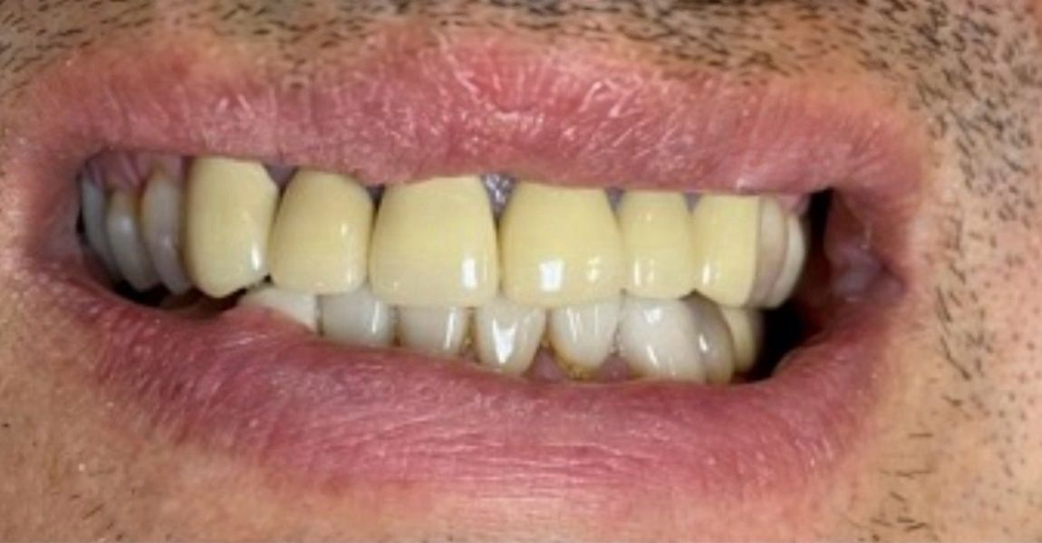A close up of a woman 's mouth with white teeth.