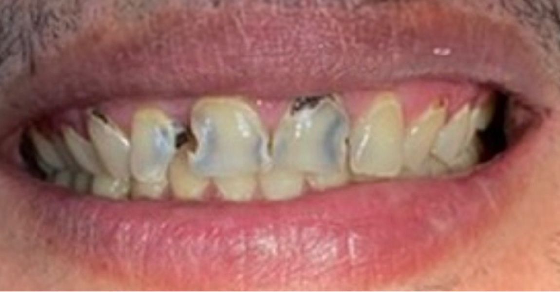 A close up of a woman 's smile with white teeth.