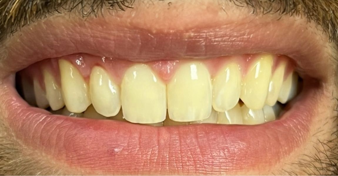 A close up of a woman 's smile with white teeth.