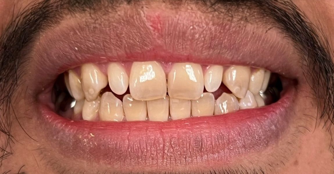A close up of a woman 's mouth with white teeth.