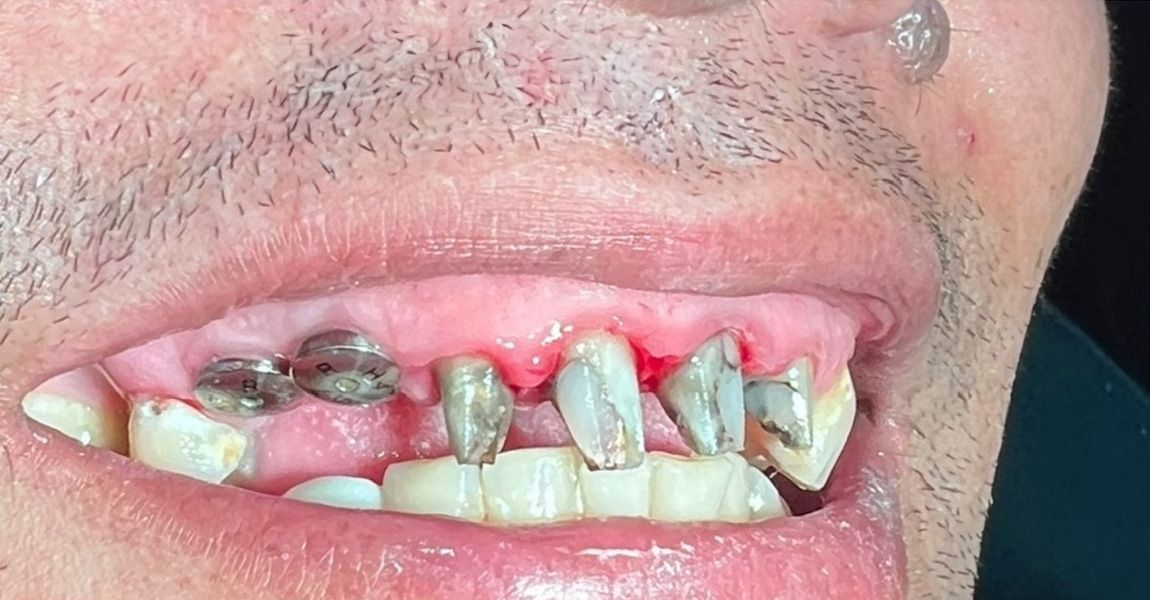 A close up of a person 's teeth with a tooth color chart.