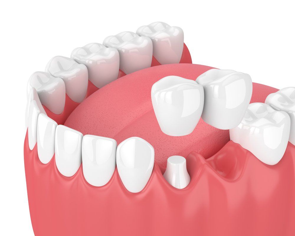 A 3d rendering of a dental bridge in a person 's mouth.