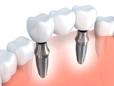 A 3d rendering of a dental bridge with two dental implants.