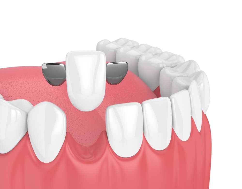 A 3d rendering of a dental bridge between two teeth.