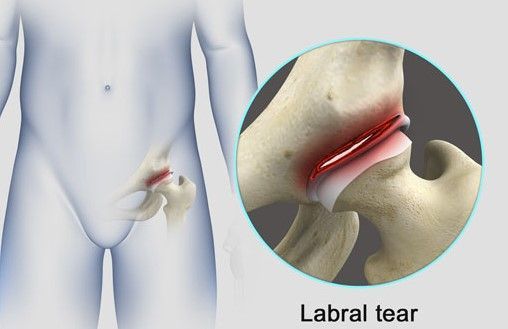 A diagram of a labral tear in a person 's knee