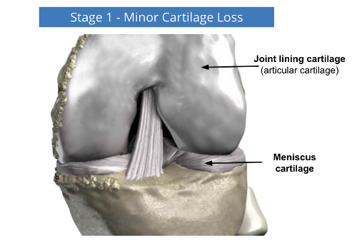A diagram of a knee showing stage 1 minor cartilage loss