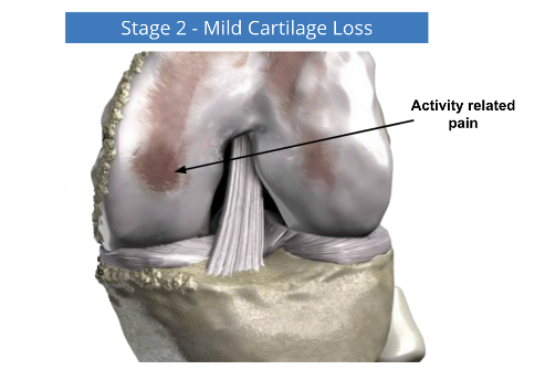 A diagram of a knee showing stage 2 mild cartilage loss