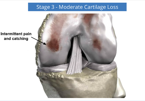 A computer generated image of a knee showing stage 3 moderate cartilage loss