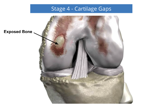 A diagram of a knee showing stage 4 cartilage gaps