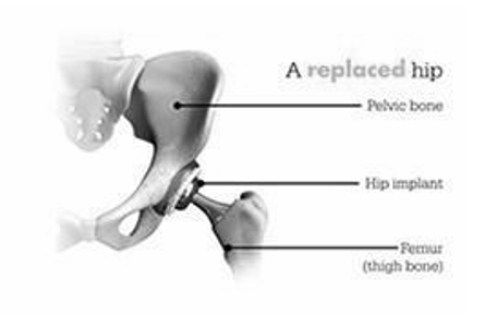 A diagram of a replaced hip with a hip implant.