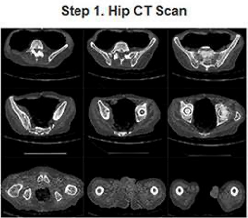 A picture of a ct scan of a person 's hip.