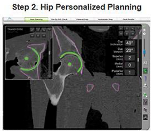 A computer screen shows a hip personalized planning process