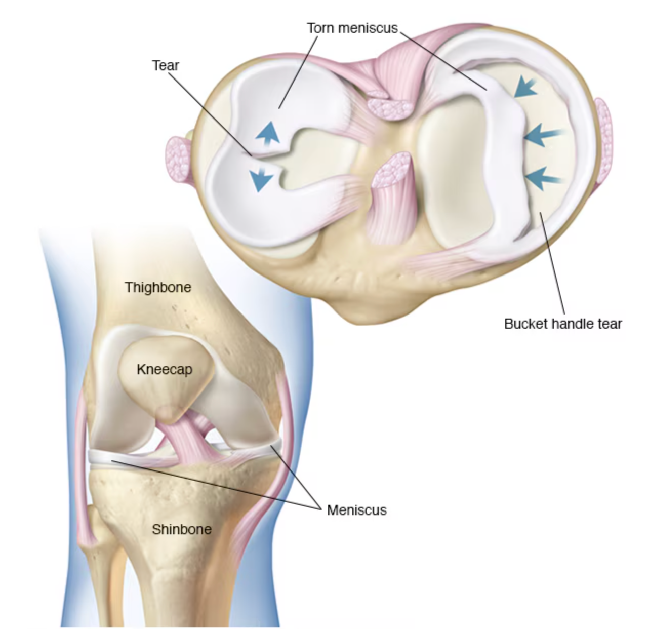 A diagram of a knee showing the bucket handle tear