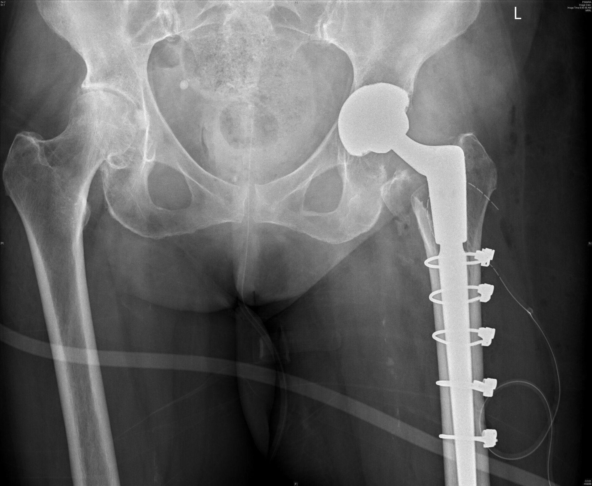 Kidney stone, urinary stone, ureteric stone, renal calculi, renal colic, nephrolithiasis