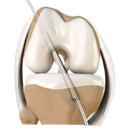 Kidney stone, urinary stone, ureteric stone, renal calculi, renal colic, nephrolithiasis