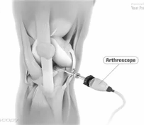 Kidney stone, urinary stone, ureteric stone, renal calculi, renal colic, nephrolithiasis