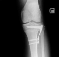ゼロからはじめる!Knee Osteotomyアップデート m3電子書籍 | ゼロからはじめる！Knee Osteotomy アップデート