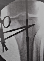 A black and white photo of a person 's knee with scissors in it.