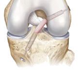 Kidney stone, urinary stone, ureteric stone, renal calculi, renal colic, nephrolithiasis