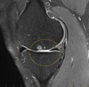 A black and white image of a knee joint with a yellow circle around it.