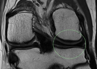 A black and white image of a knee joint with a green circle around it.