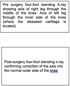 Pre surgery four-foot standing x-ray showing axis of right leg through the middle of the knee