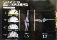 A screen shows a range of motion for a knee