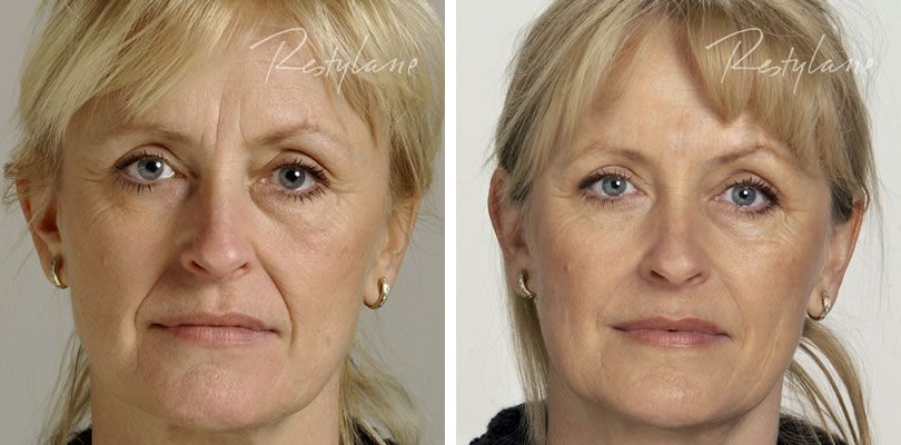 Galderma Fillers - A before and after photo of a woman 's face.