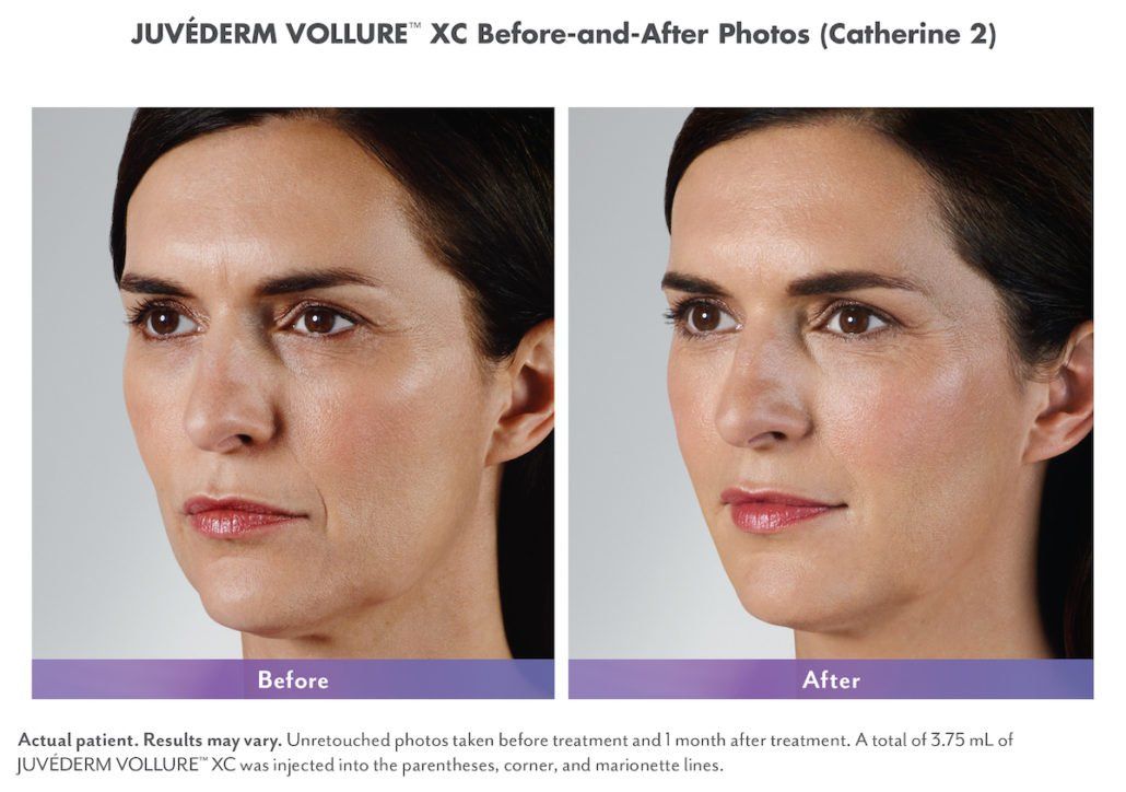 A before and after photo of a woman 's face before and after Juvéderm 