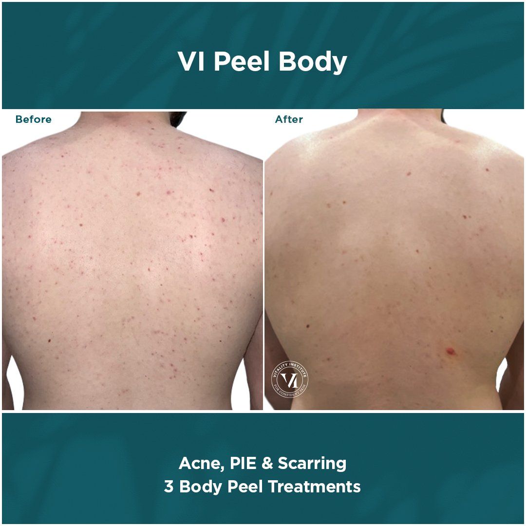 Vi Peel results- A before and after picture of a person 's back