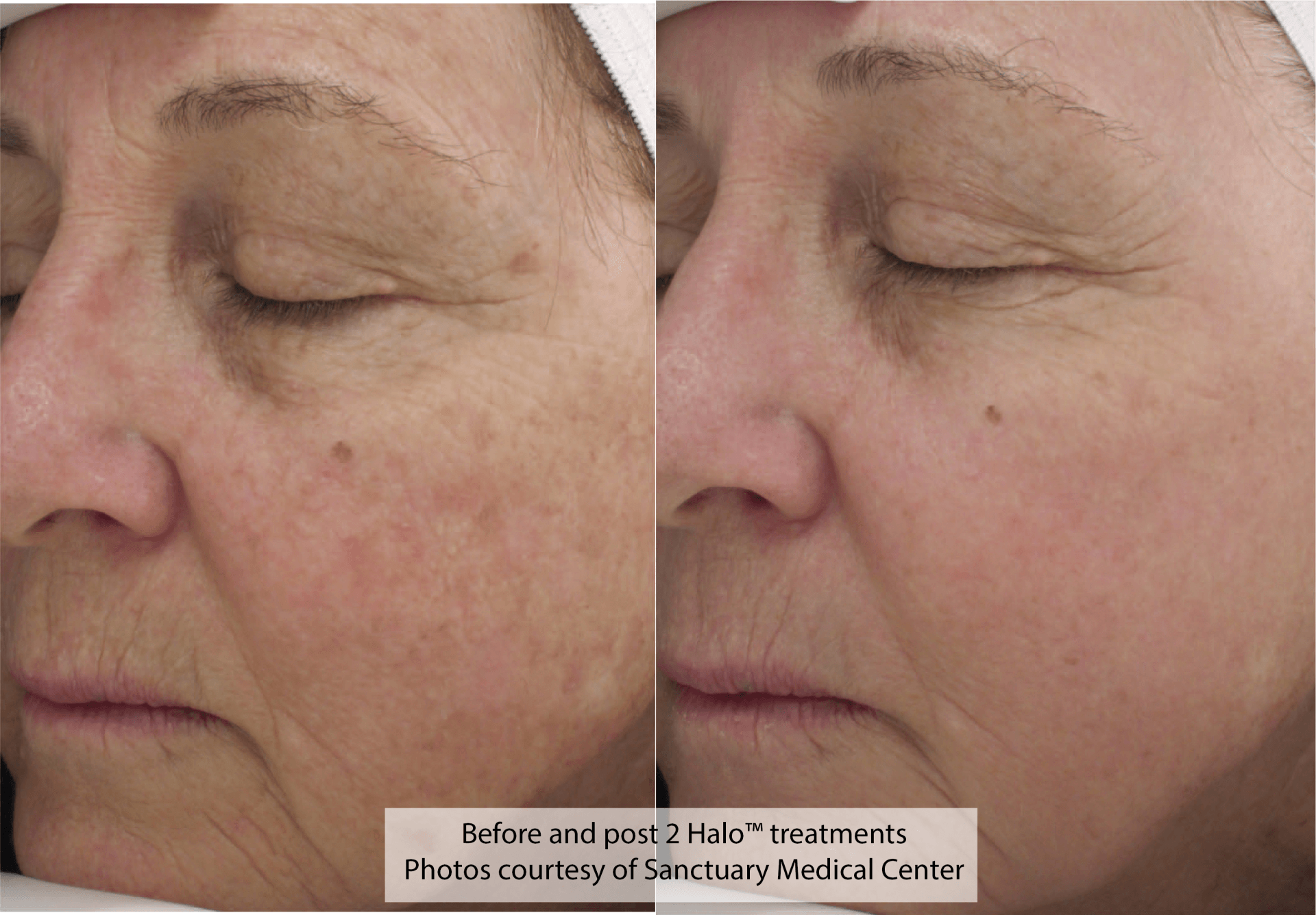 Halo Results- A before and after photo of a woman 's face.
