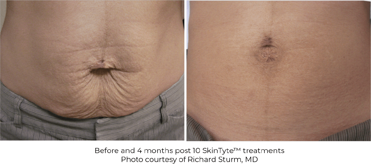 SkinTyte results-A before and after photo of a person's stomach 