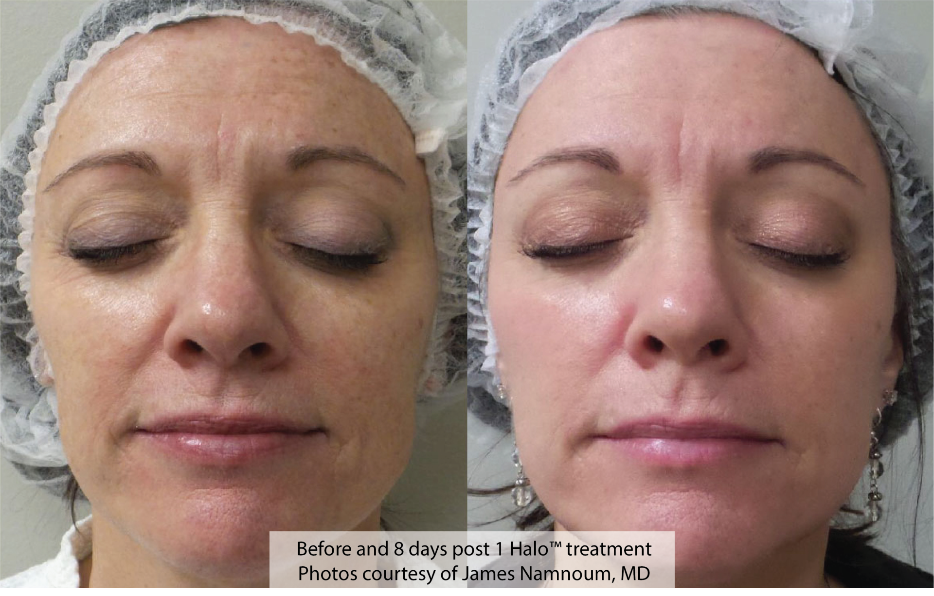 Halo Results- A before and after photo of a woman 's face.