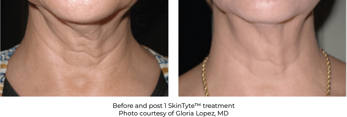 SkinTyte results- A before and after photo of a woman 's neck