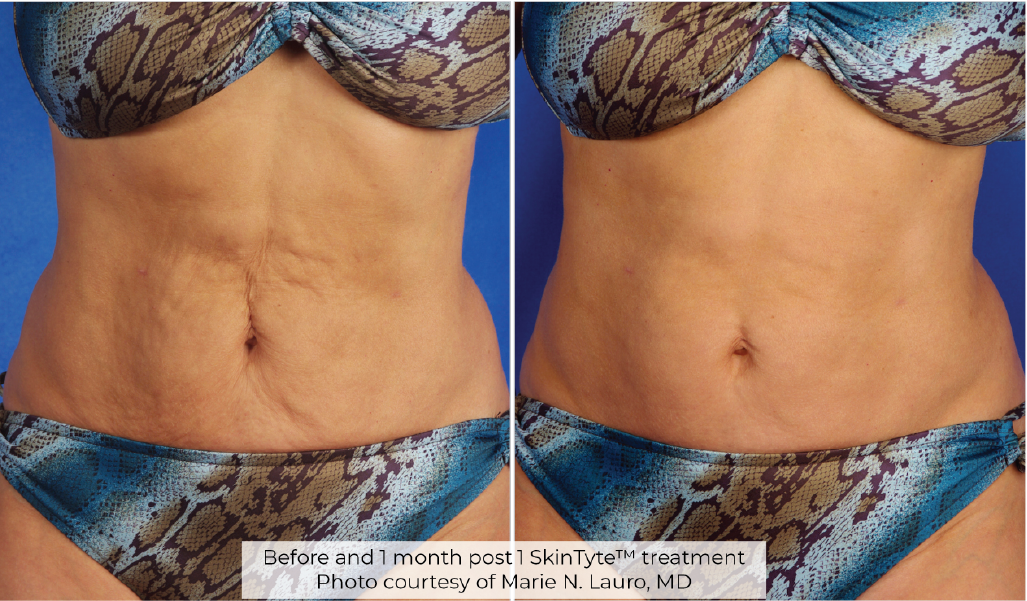  SkinTyte results- A before and after photo of a woman 's stomach