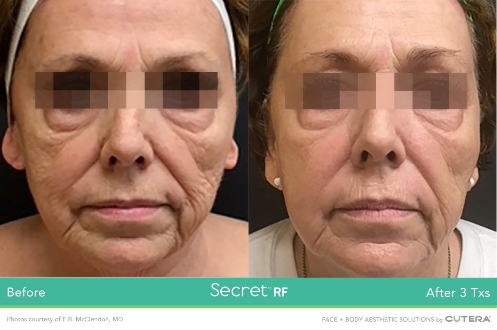 Photo of a woman 's face before and after using Secret RF